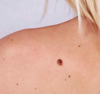 Пигментная родинка
