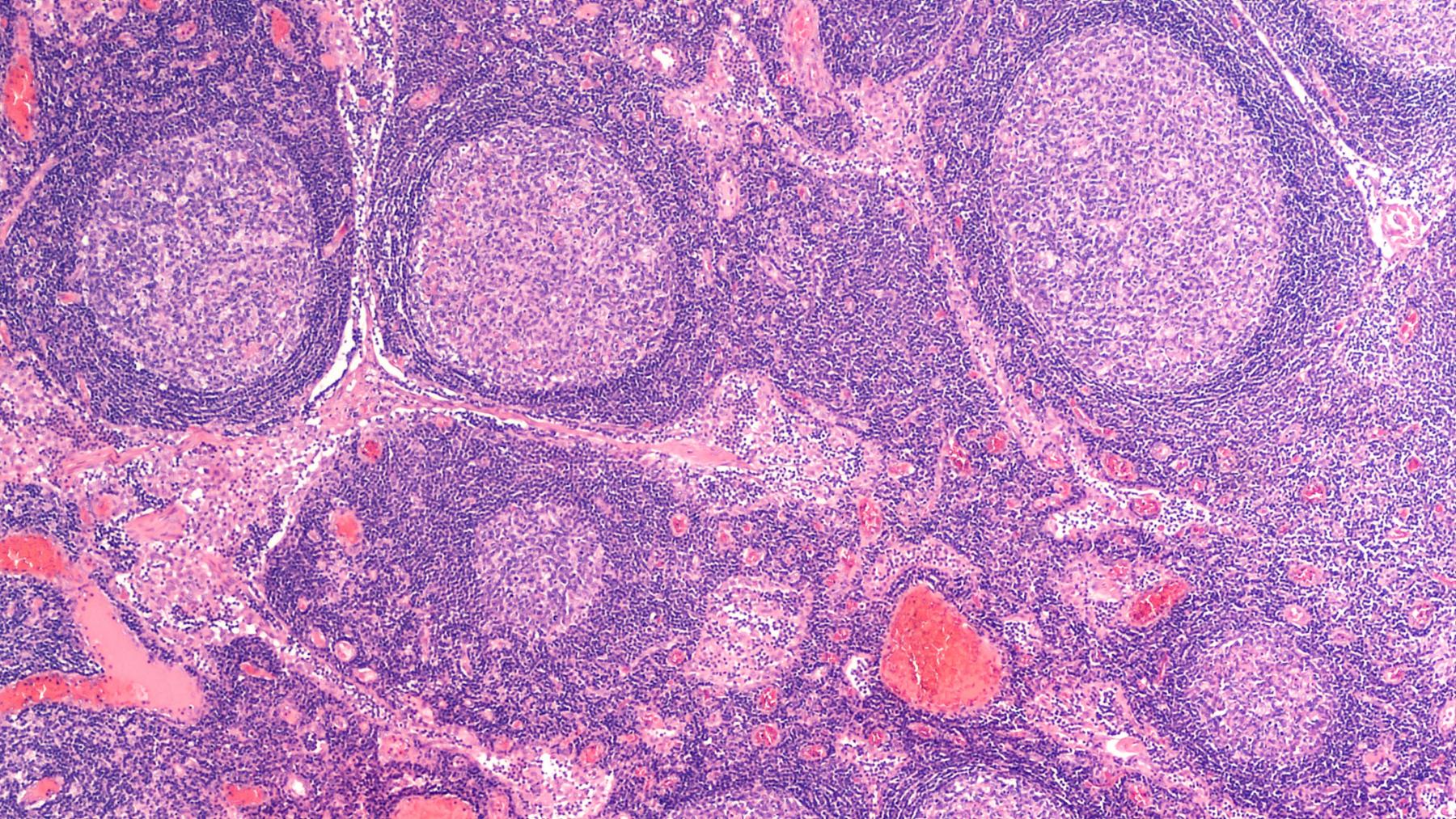 метастазы в лимфоузлах